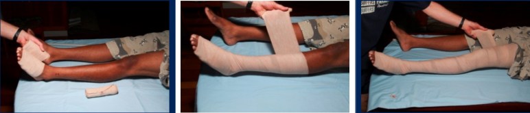 Compression bandaging to treat snake bite